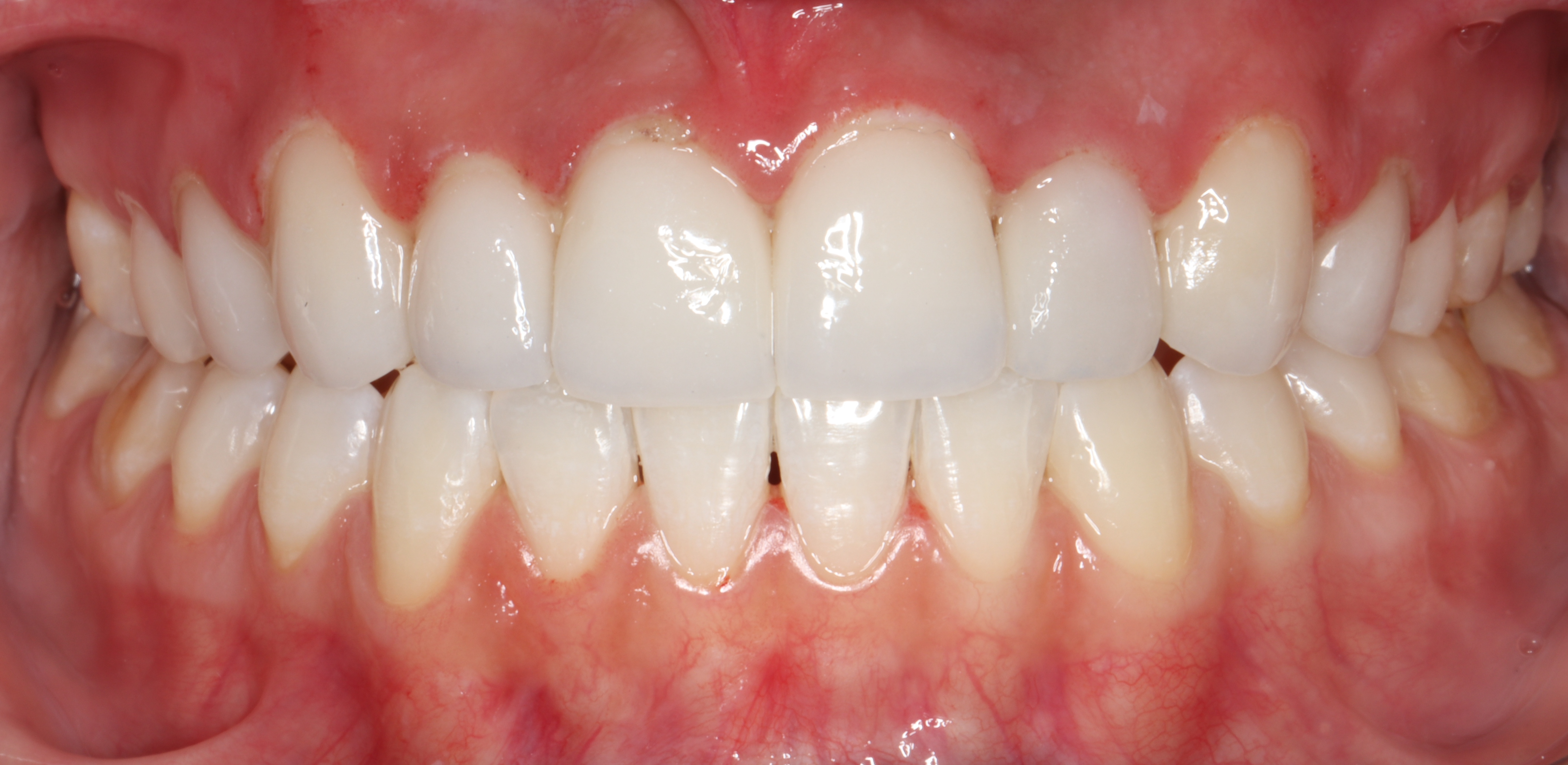 След лечение - Ортодонтско лечение - dentAlive