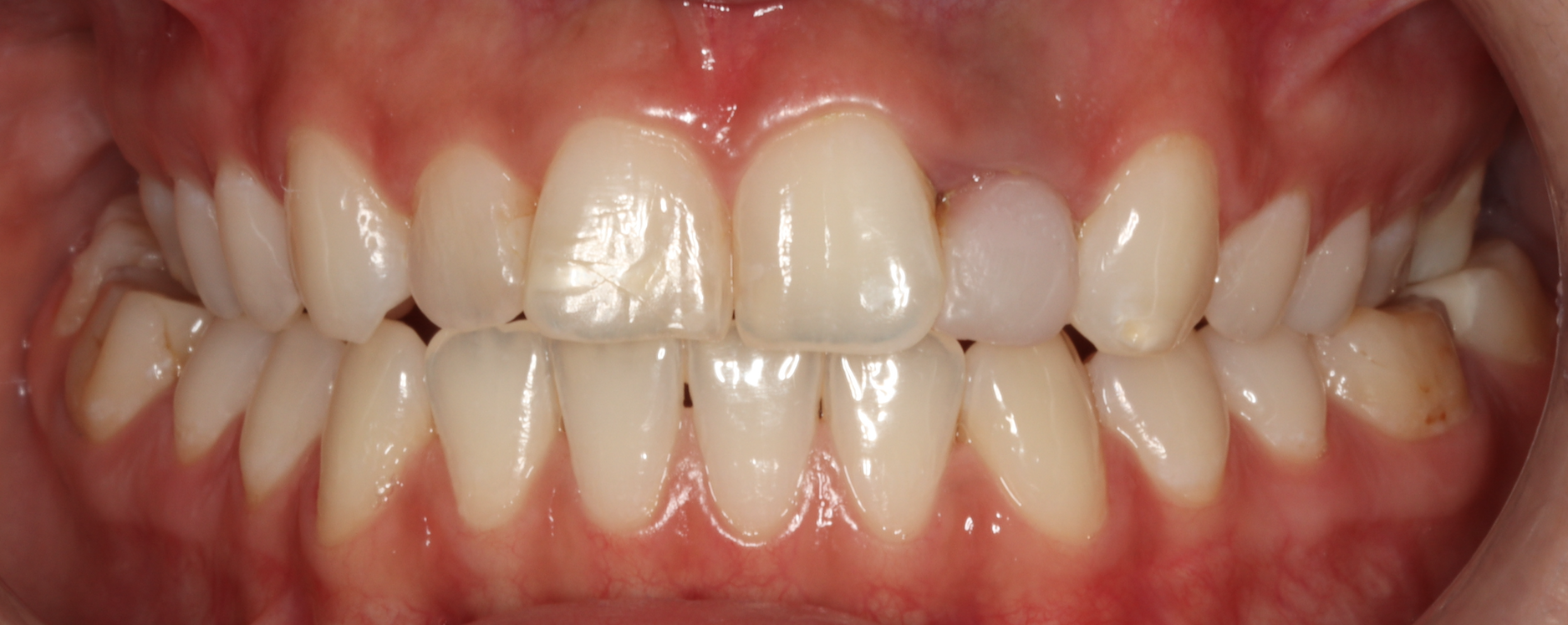 Преди лечение - Ортодонтско лечение - dentAlive