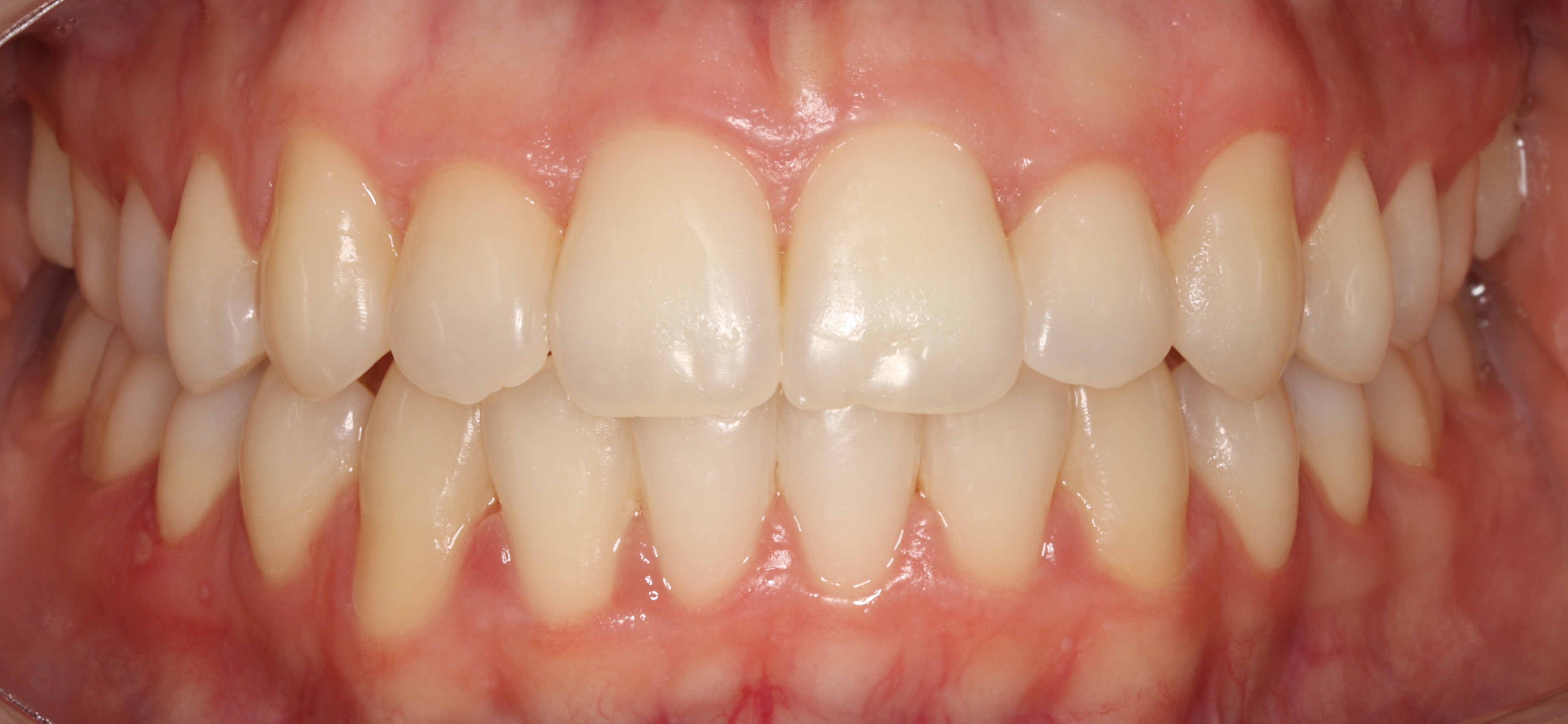 След лечение - Ортодонтско лечение - dentAlive