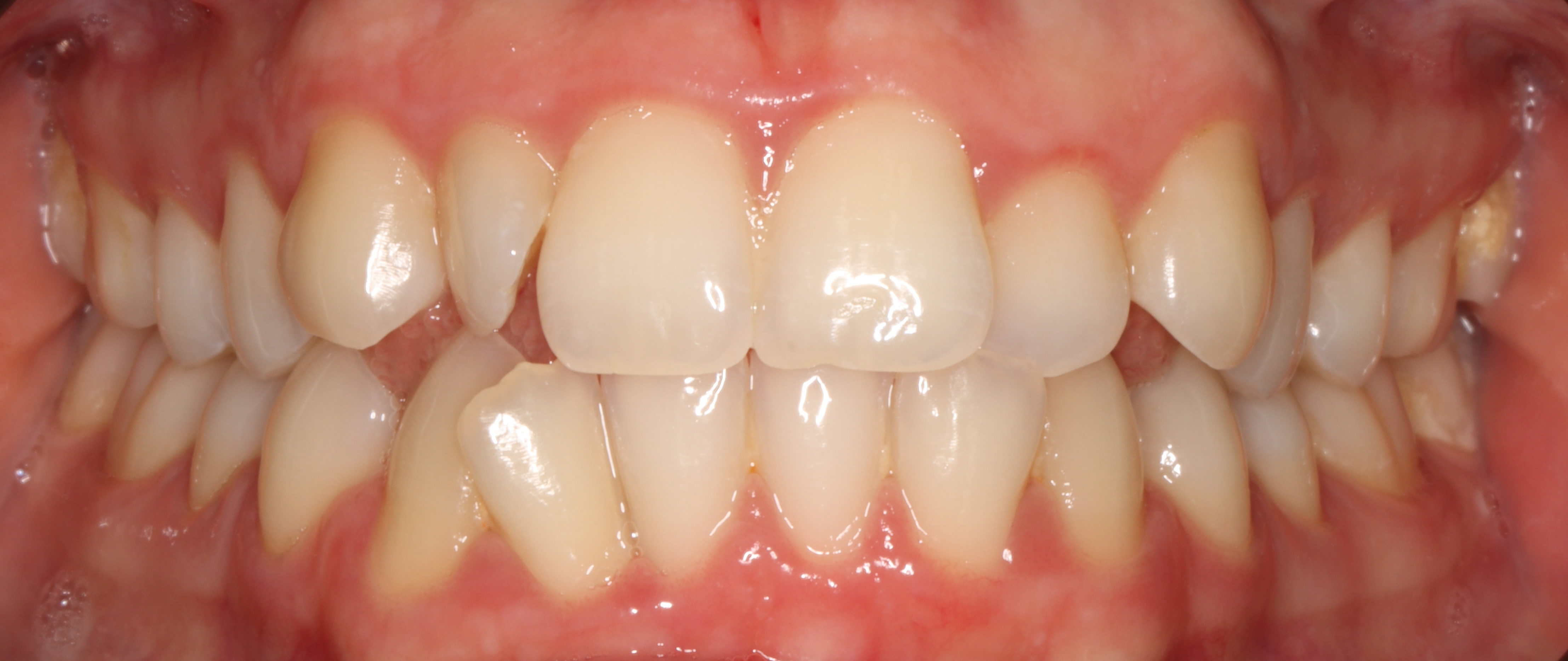 Преди лечение - Ортодонтско лечение - dentAlive