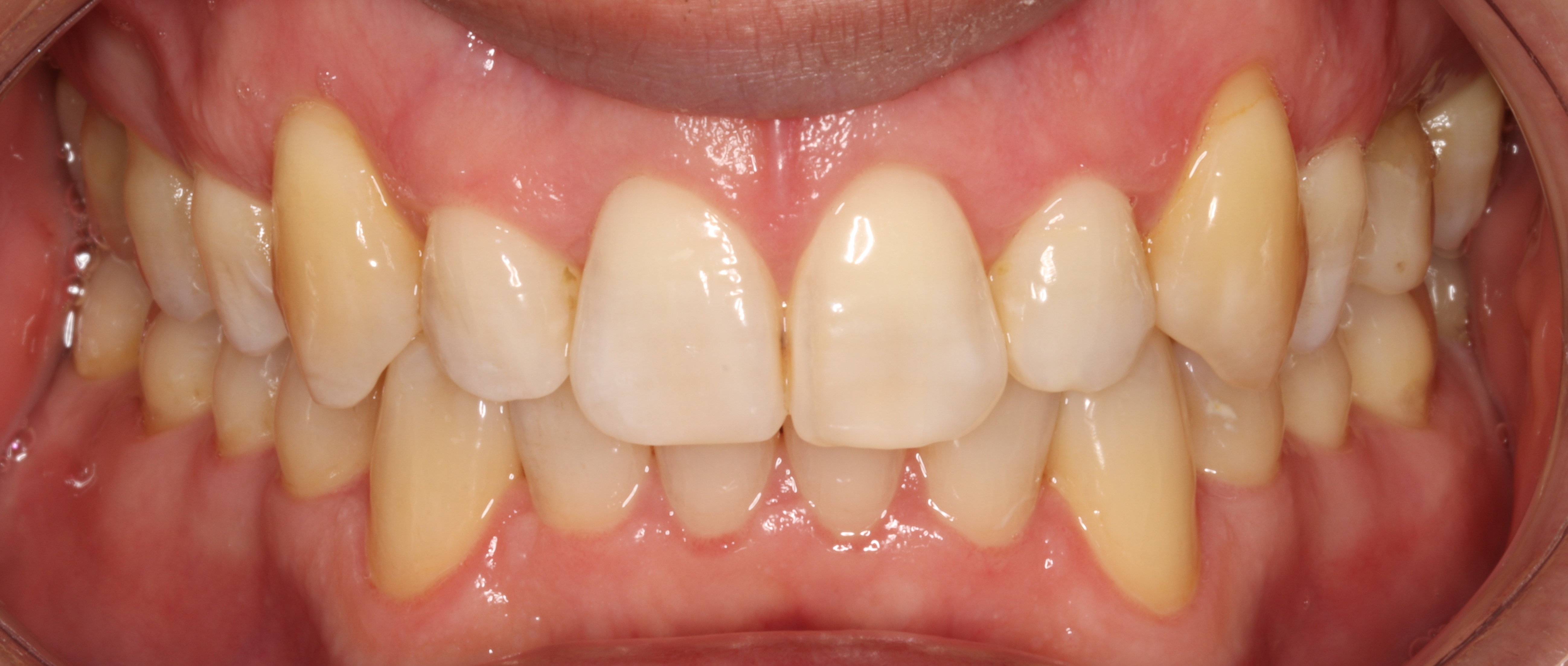 След лечение - Ортодонтско лечение - dentAlive