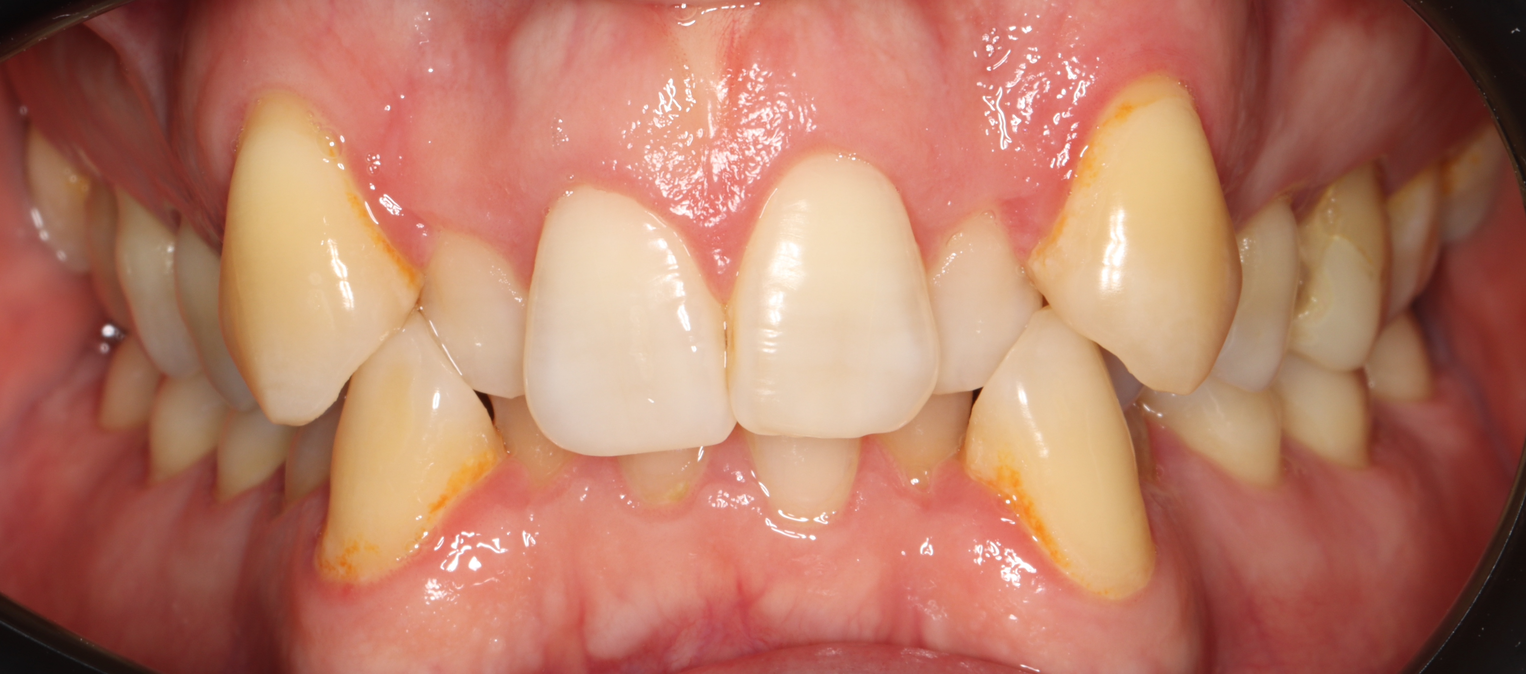 Преди лечение - Ортодонтско лечение - dentAlive